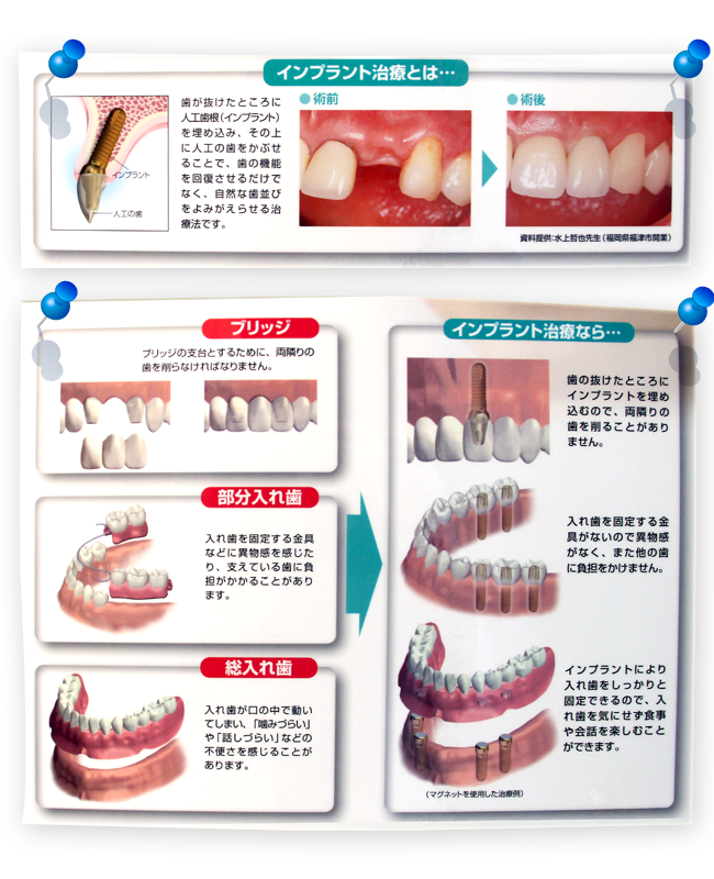 インプラント治療をご存知ですか？